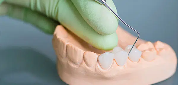 Close up of teeth moulding